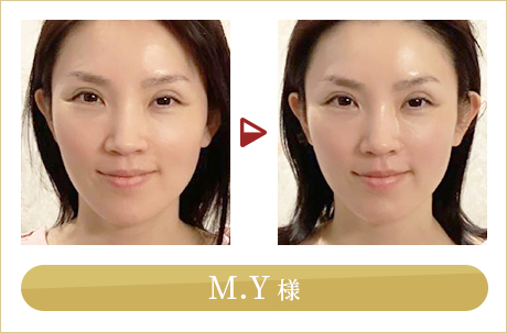 before after