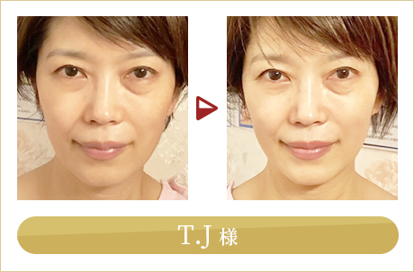 before after