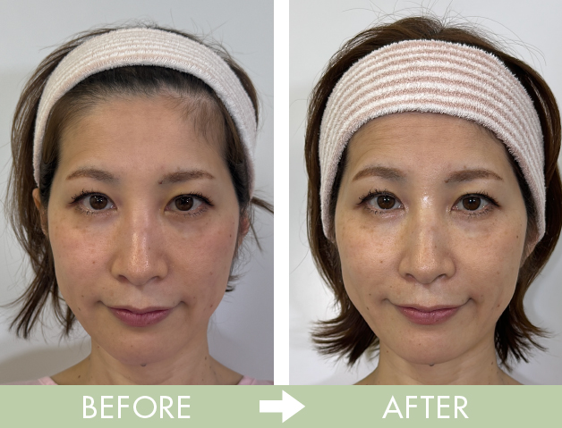 美容鍼のビフォーアフター